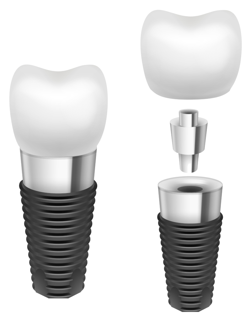 İmplant tedavi süreci